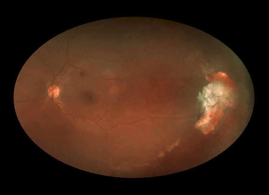 Sickle Cell Retinopathy Photograph by Paul Whitten