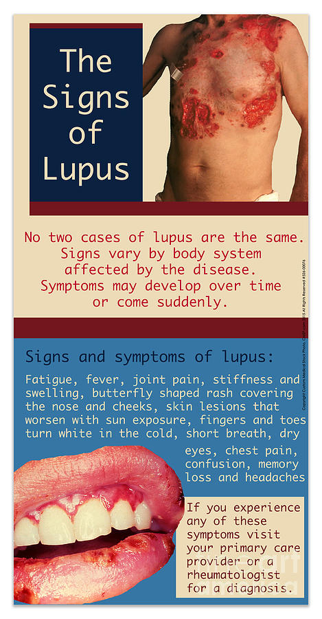 Signs of Lupus Digital Art by Cmsp
