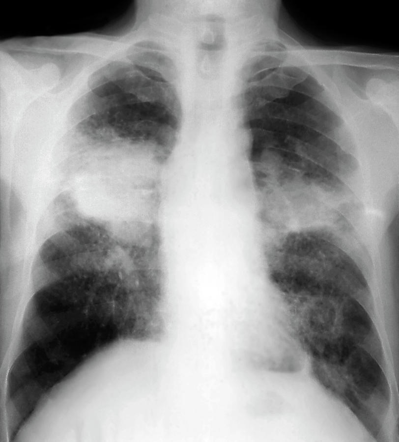 Silicotuberculosis Of The Lungs Photograph by Zephyr/science Photo Library