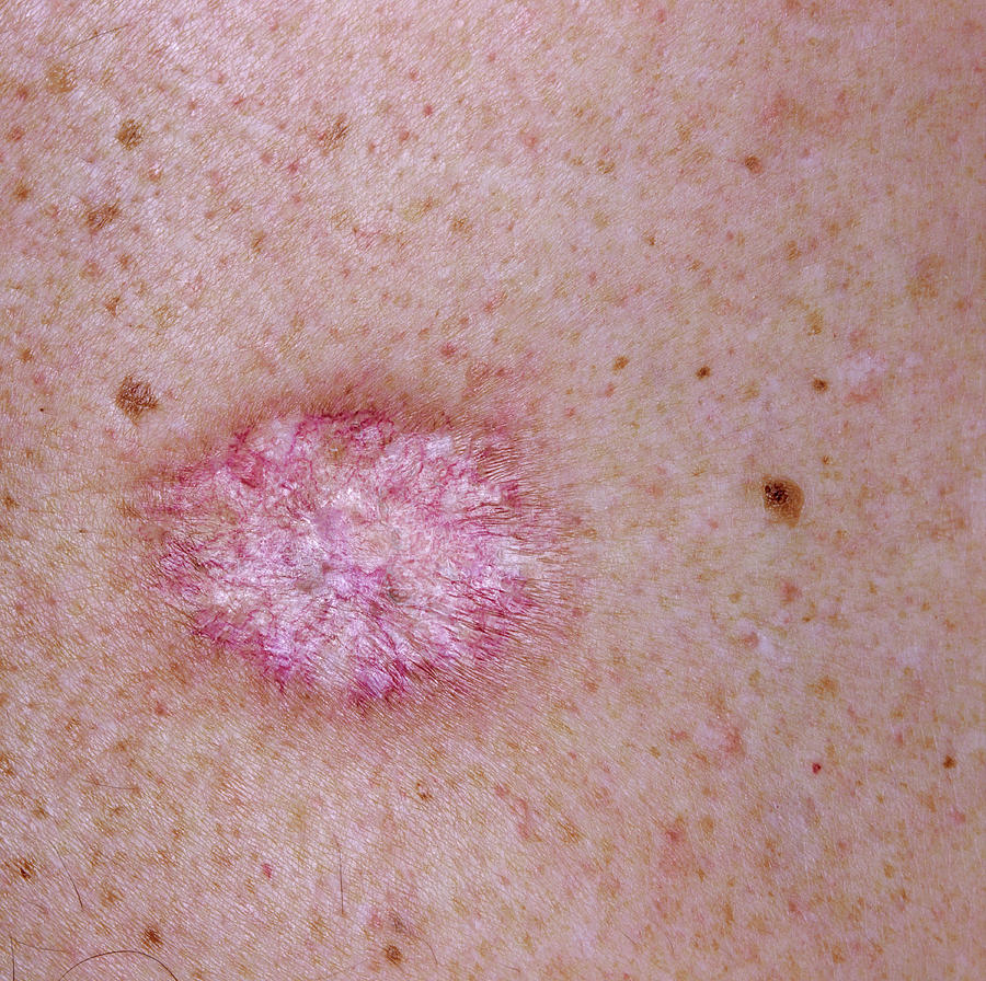 Skin Cancer Photograph by Alex Bartel/science Photo Library - Fine Art ...