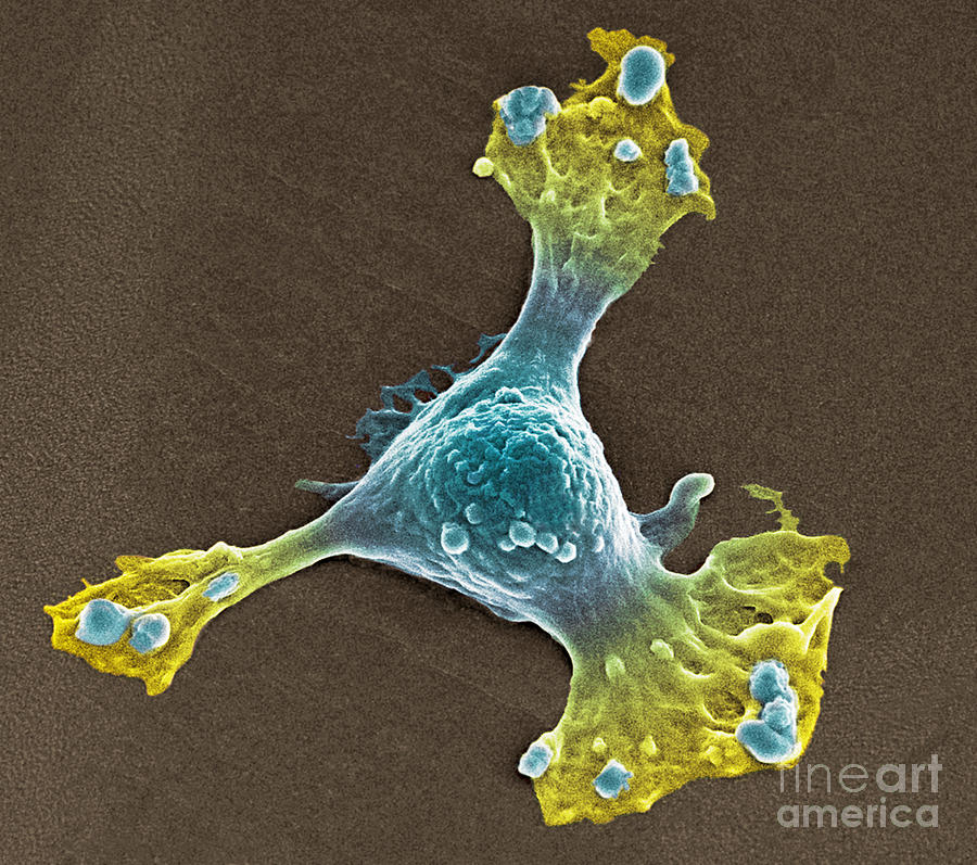 Skin cancer cell SEM Photograph by Spl
