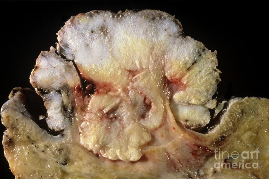 Squamous Cell Carcinoma Photograph - Skin Cancer by Cnri