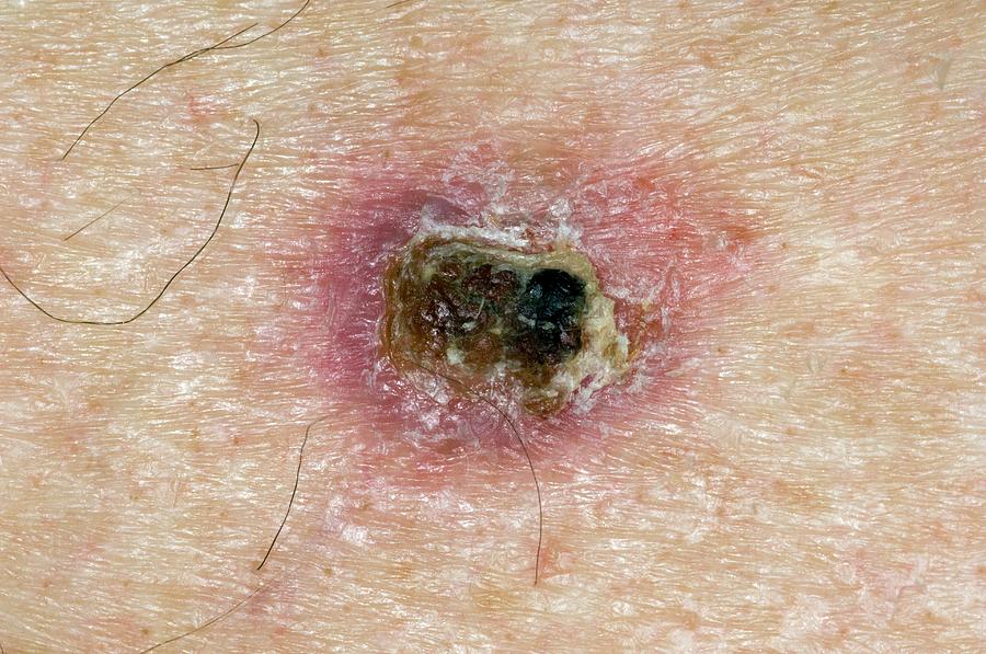 Skin Cancer On Shoulder Photograph by Dr P. Marazzi/science Photo Library