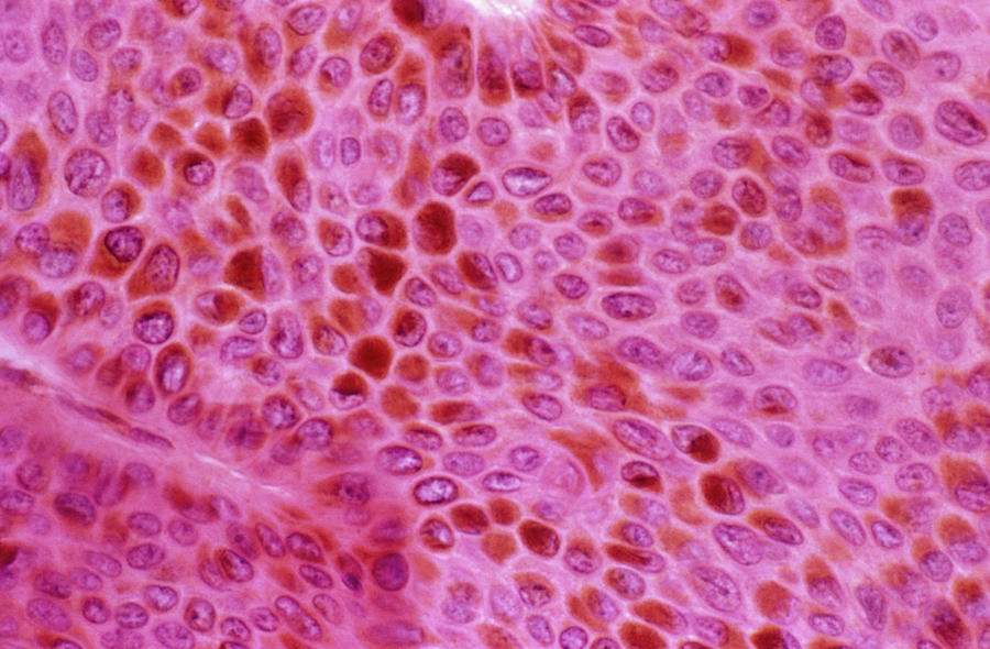 Skin Lesion Photograph by Cnri/science Photo Library