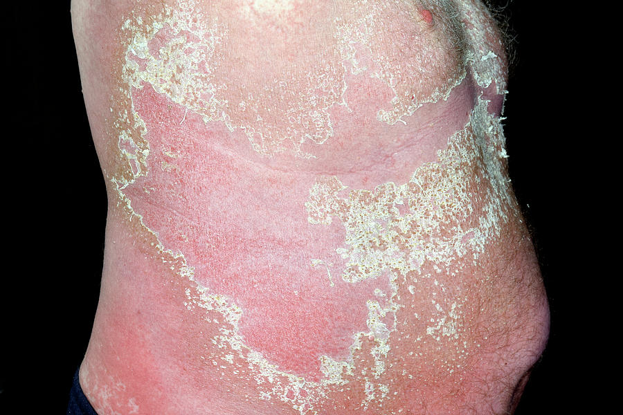 skin-peeling-in-allergic-reaction-photograph-by-dr-p-marazzi-science