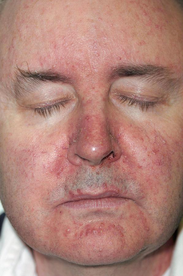 Skin Rash Following Chemotherapy Photograph by Dr P. Marazzi/science ...