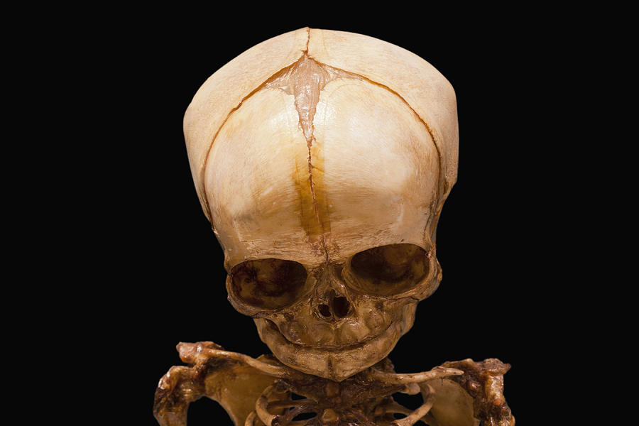 Skull At Birth Photograph by Science Stock Photography