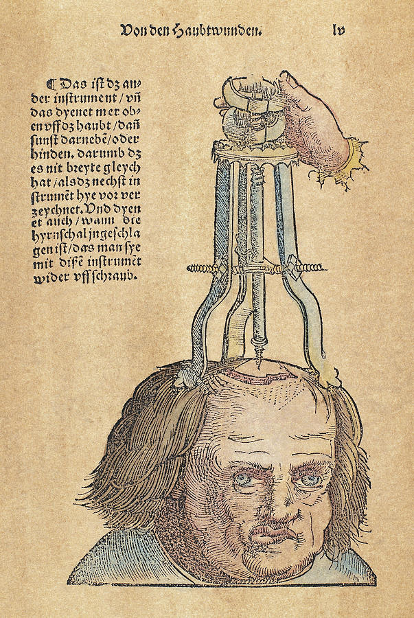 Skull Operation, 1517 Photograph by Granger