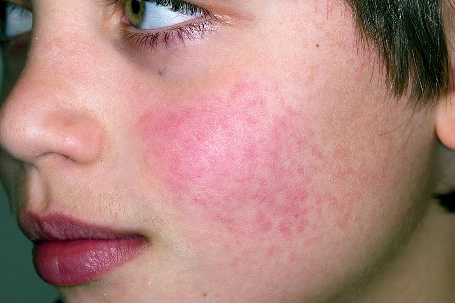 slapped-cheek-disease-photograph-by-dr-p-marazzi-science-photo-library