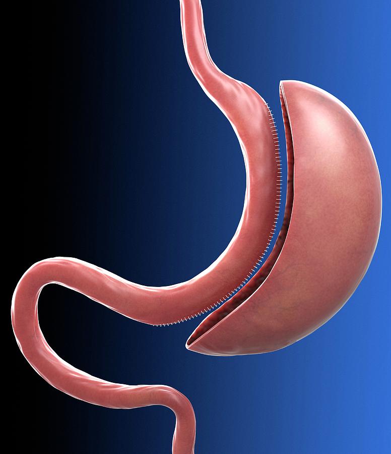 Sleeve Gastrectomy Photograph by Tim Vernon / Science Photo Library