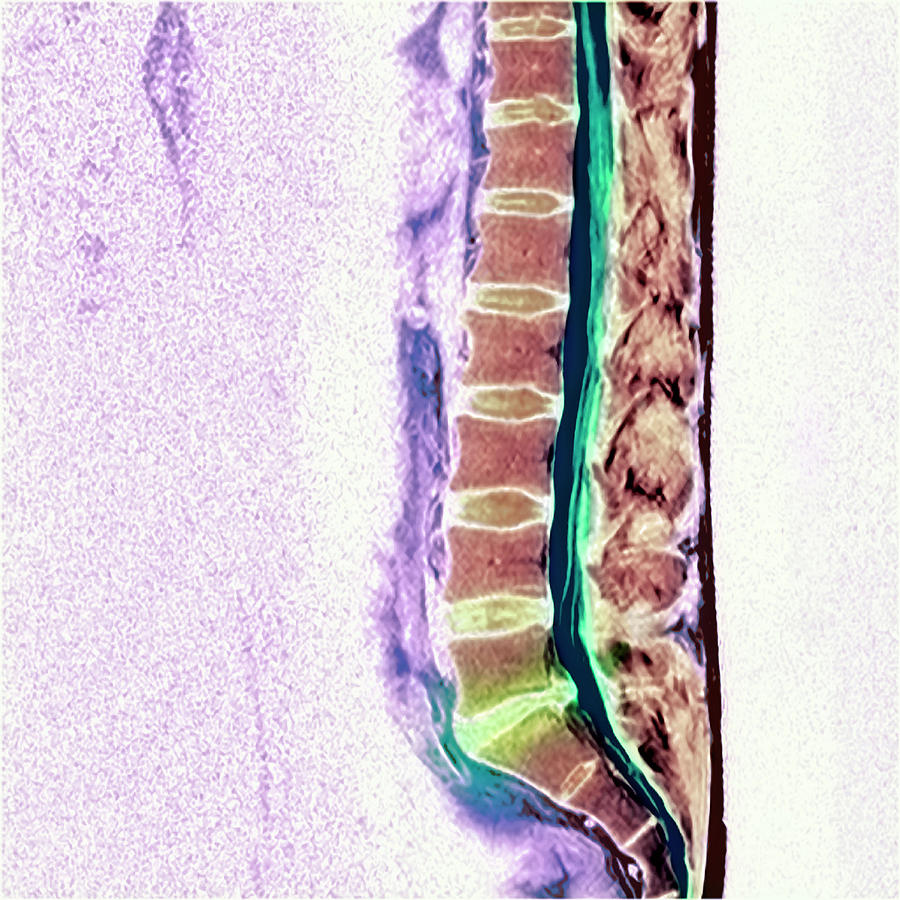 Slipped Disc Photograph by Simon Fraser/science Photo Library