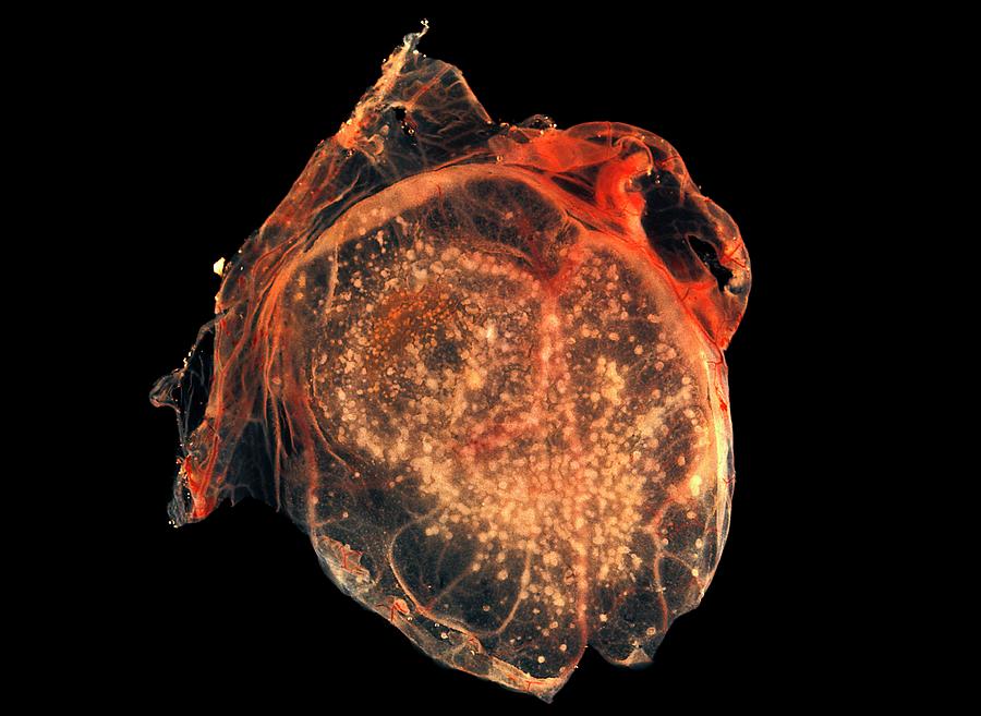 Smallpox Research Photograph by Cdc/science Photo Library - Pixels