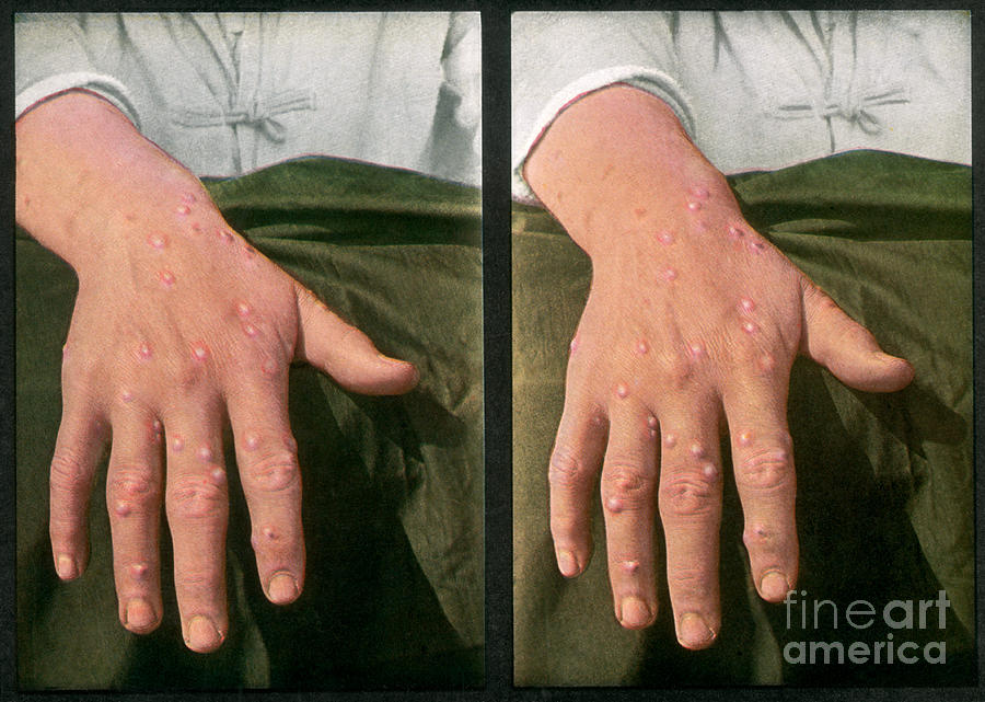 Smallpox, Vintage Stereoscopic Image Photograph by DoubleVision