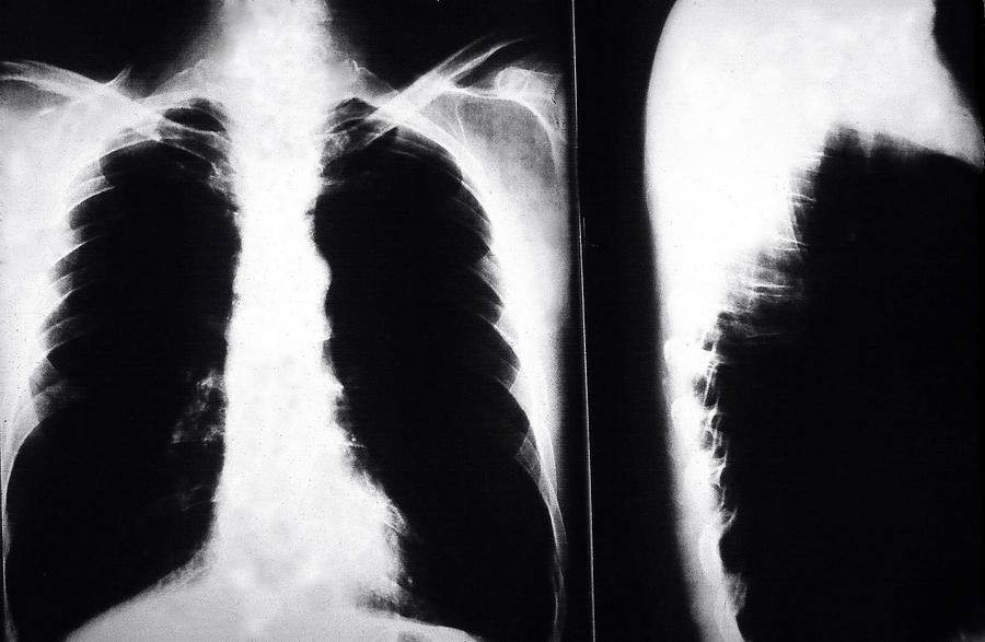 Smoker Photograph - Smokers cancerous lungs. by Oscar Williams
