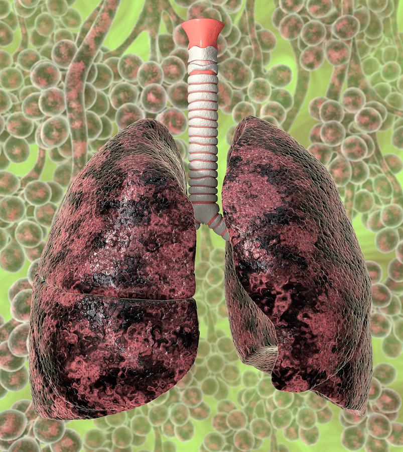 Smokers Lungs Photograph by Animated Healthcare Ltd/science Photo Library