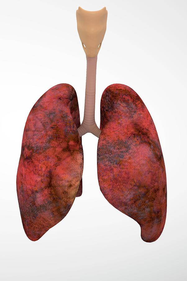 Smoker's Lungs by Ella Maru Studio / Science Photo Library