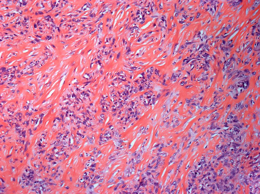 Smooth Muscle Cancer Photograph by Steve Gschmeissner