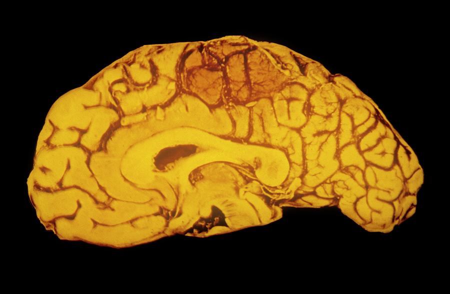 Cerebral Haemorrhage Photograph - Specimen Human Brain Showing Haemorrhage by Cnri/science Photo Library