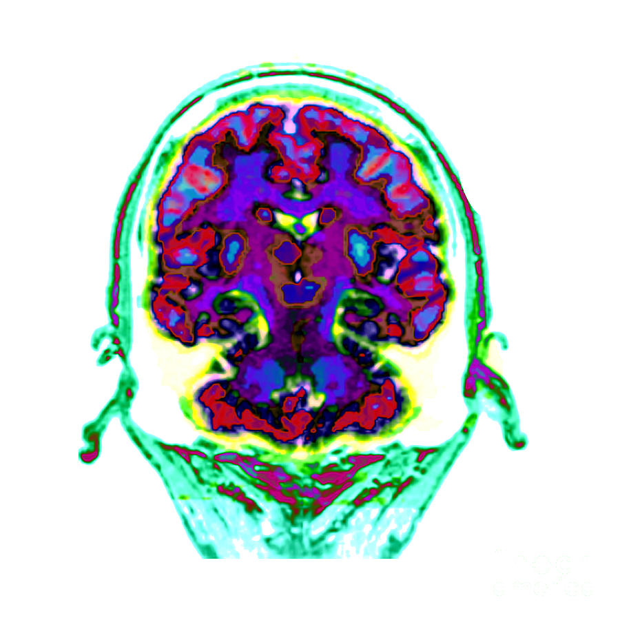 Spect Exam Of Human Brain Photograph by Living Art Enterprises