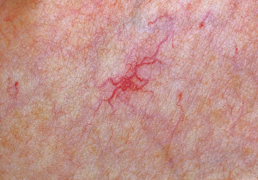 Spider Naevus On Skin Photograph by Dr H.c.robinson/science Photo ...