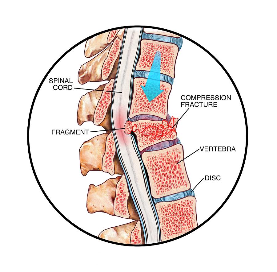 best way to sleep with compression fracture best way to sleep with compression fracture