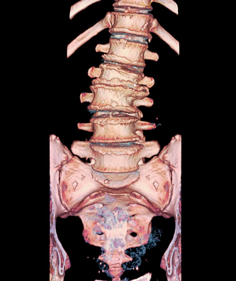 old t8 compression fracture treatment