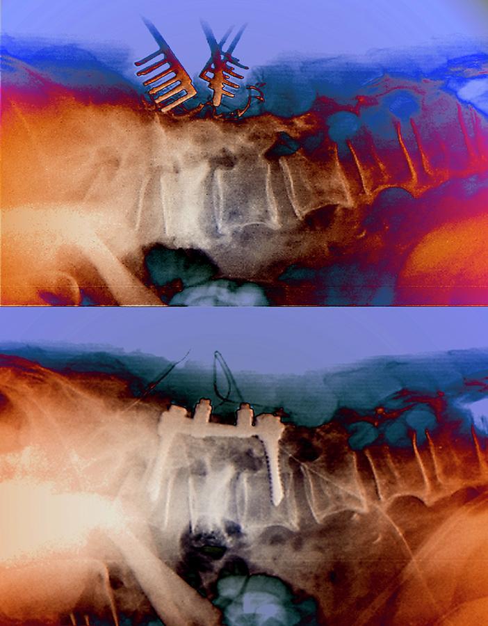 Device Photograph - Spinal Compression Fractures In Surgery by Zephyr