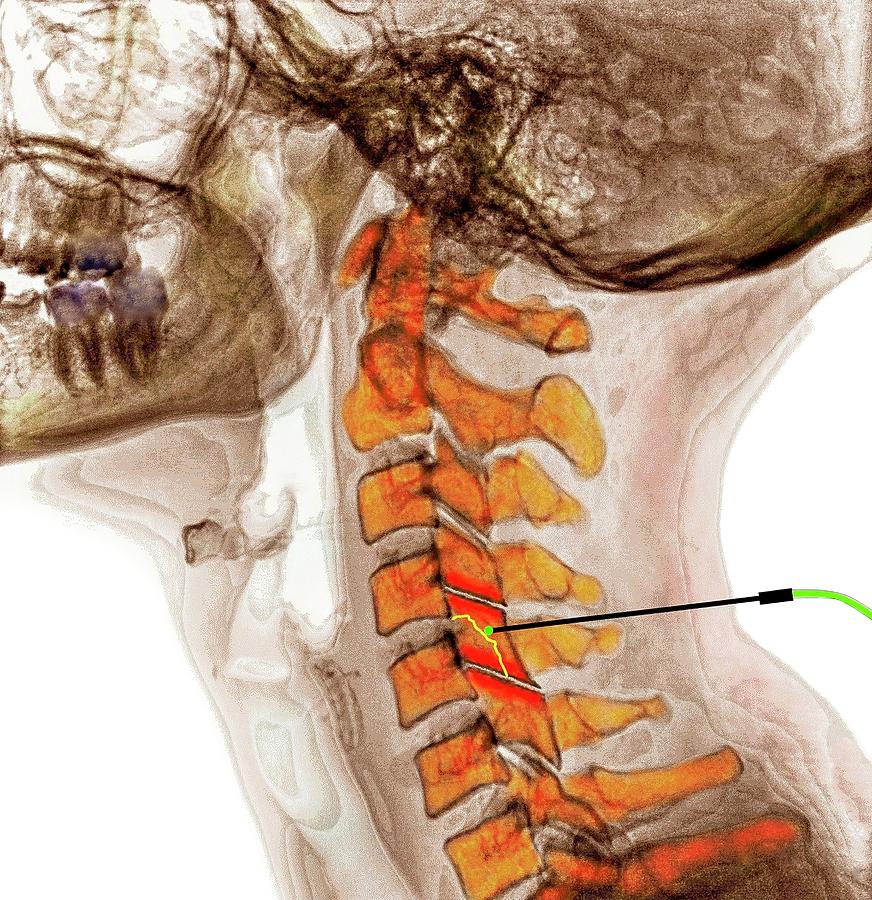 Spinal Facet Joint Nerve Ablation Photograph by Medical Media Images ...