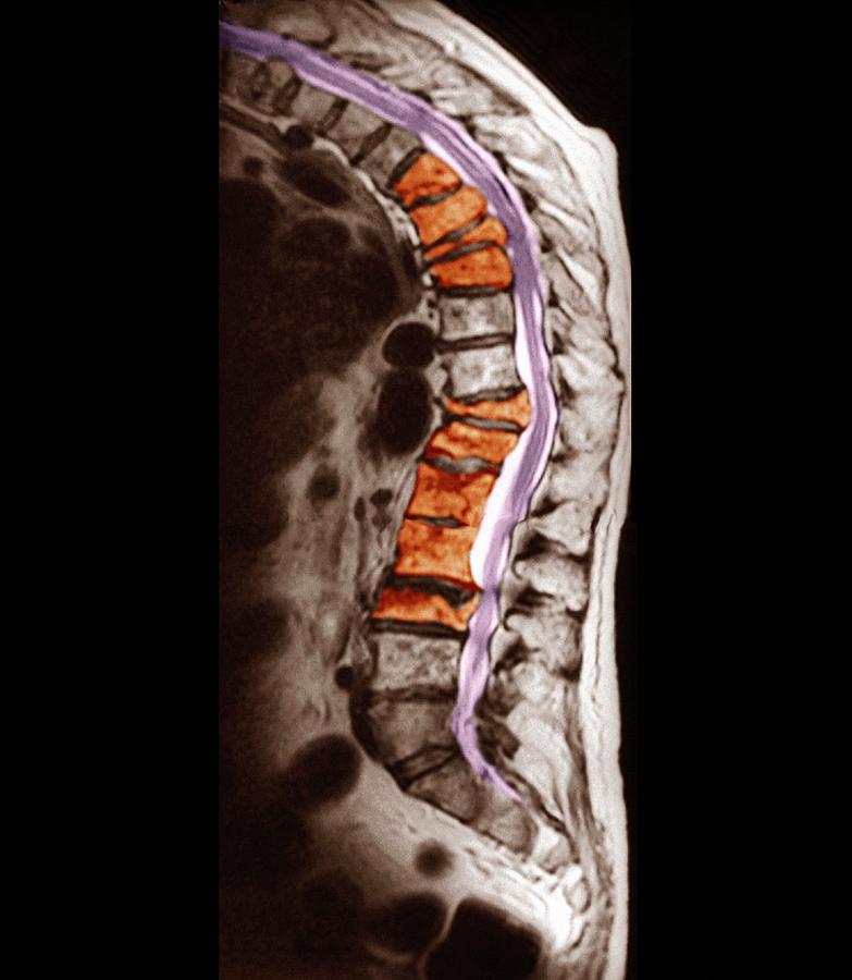 Spinal Osteoporosis Photograph by Zephyr/science Photo Library Pixels