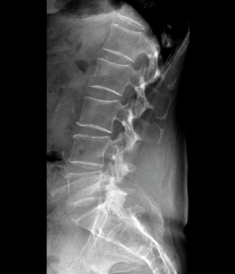 Spinal Stenosis After Surgery Photograph by Zephyr