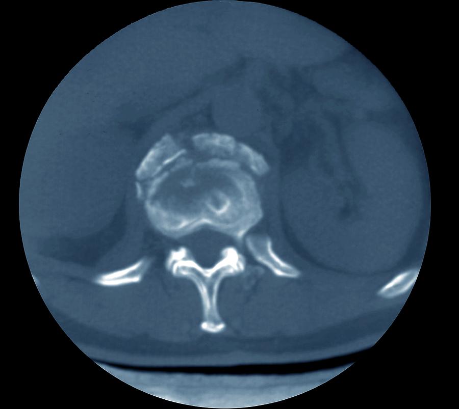 bone fragments in knee