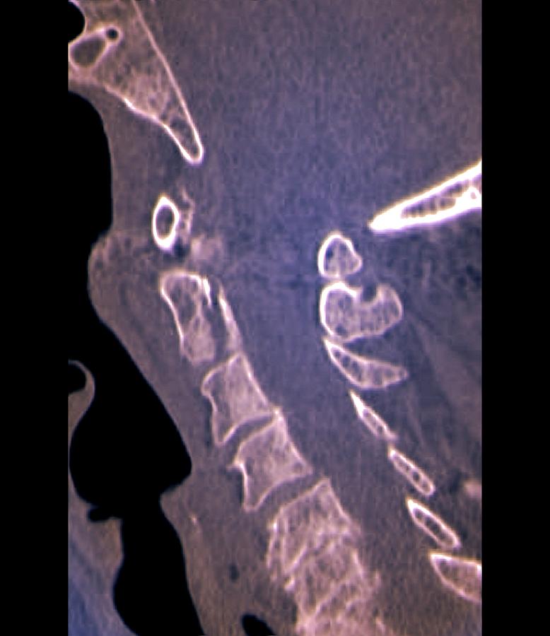 Spine Fracture Photograph by Zephyr/science Photo Library