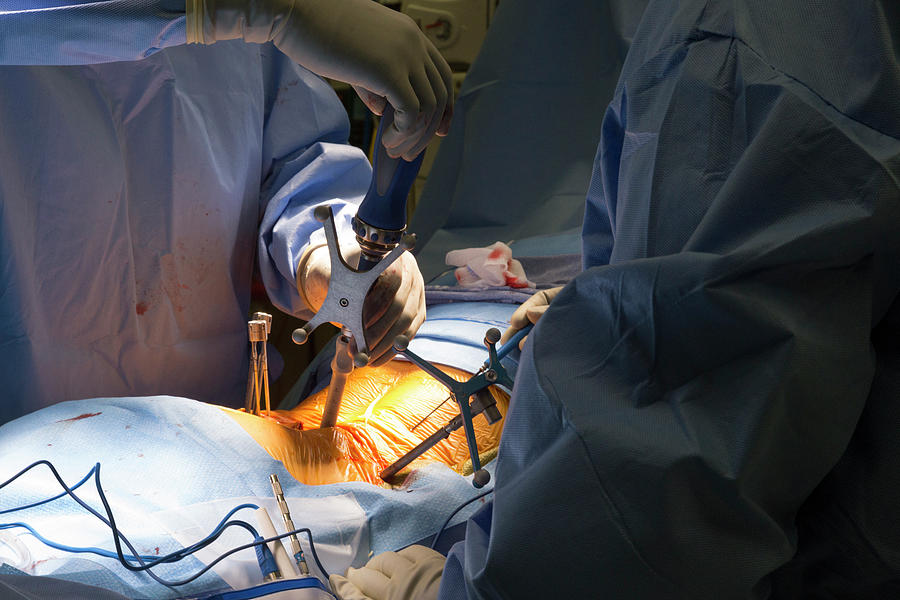 Spine Surgery Photograph By Jim West Science Photo Library