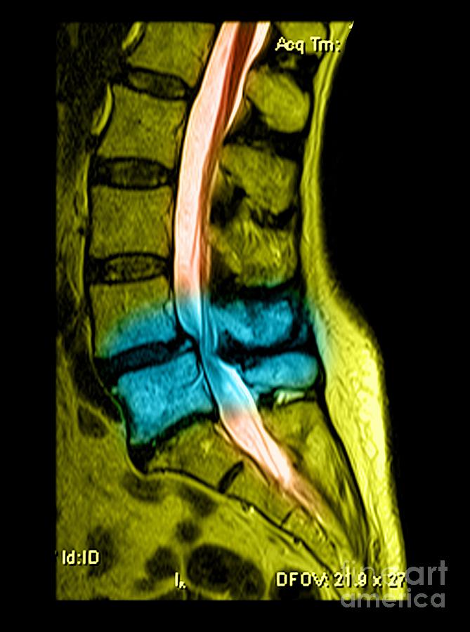 Spondylolisthesis and Canal Stenosis Photograph by Medical Body Scans