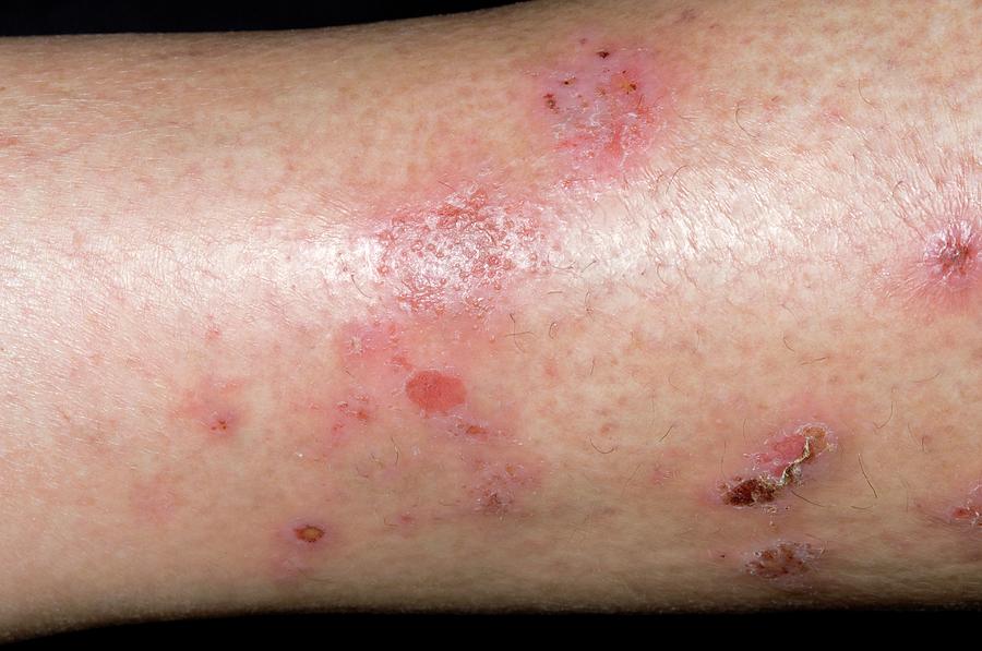 Spongiotic Dermatitis On The Leg Photograph By Dr P Marazziscience Photo Library