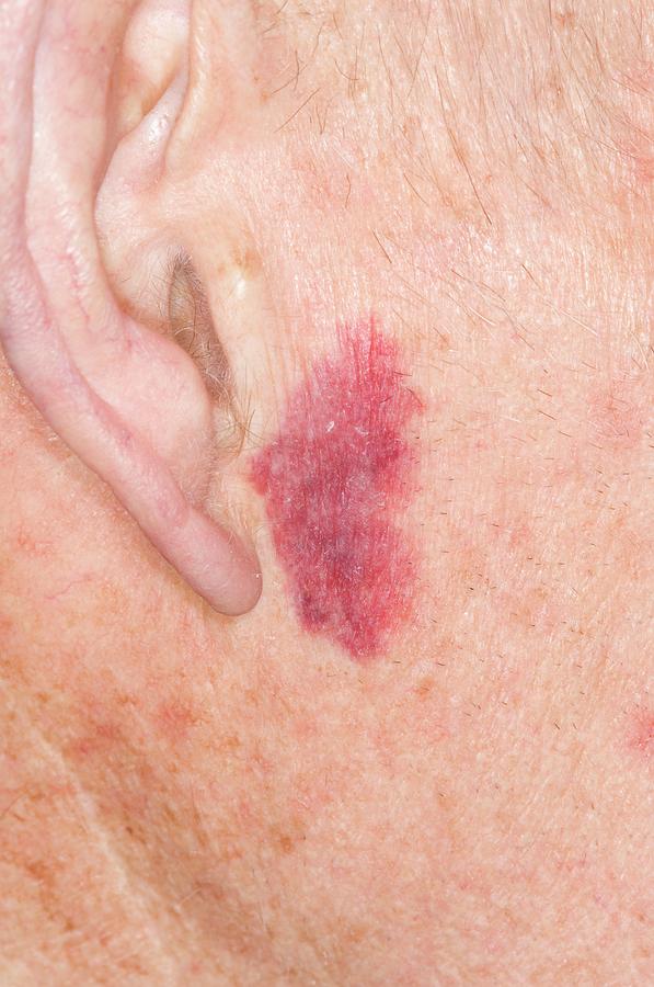 Spontaneous Bruise On The Cheek Photograph by Dr P. Marazzi/science ...