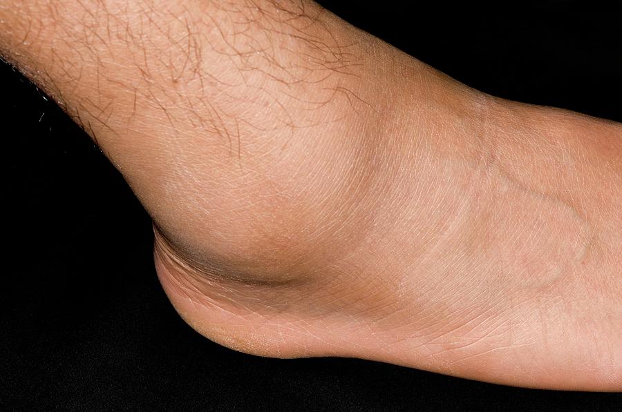 sprained-ankle-sport-s-injury-photograph-by-dr-p-marazzi-science-photo