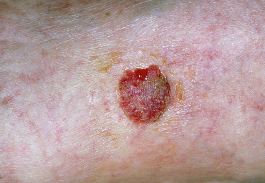 Squamous Cell Cancer Of Skin On Leg Photograph By Dr P Marazziscience Photo Library 9720