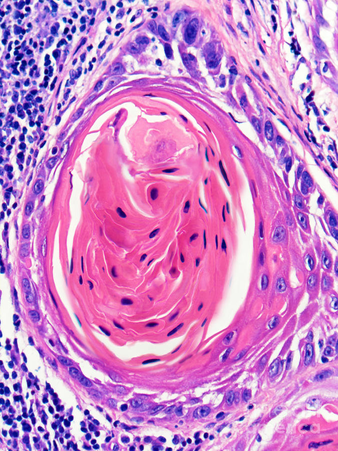Squamous Cell Carcinoma, Keratin Pearl Photograph by Garry DeLong