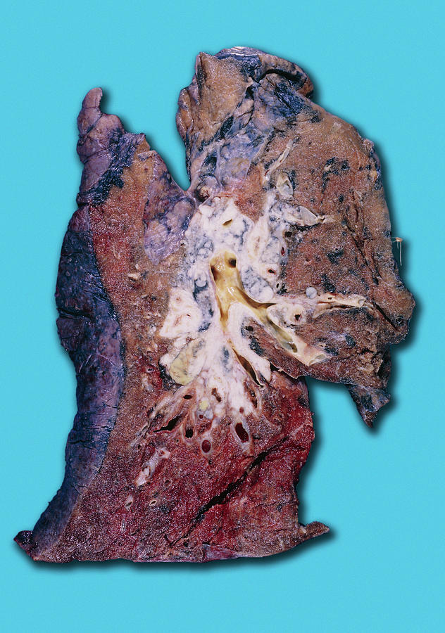 Squamous Cell Carcinoma Lung Cancer Photograph by Medimage