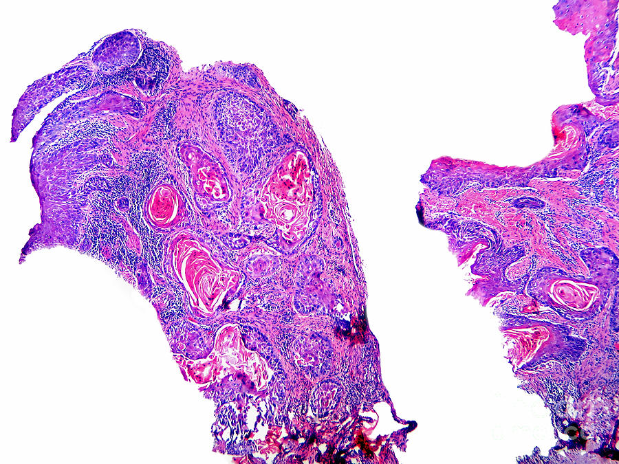 Squamous Cell Carcinoma, Odontogenic Photograph by Garry DeLong