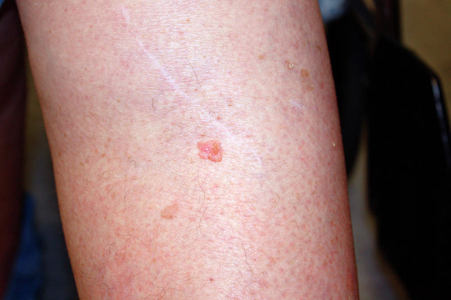 Squamous Cell Carcinoma Photograph - Squamous Cell Carcinoma On A Leg by National Cancer Institute/science Photo Library