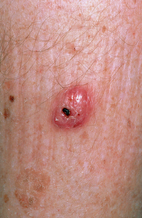 Squamous Cell Carcinoma On Leg Photograph By Dr P Marazziscience Photo Library 3192