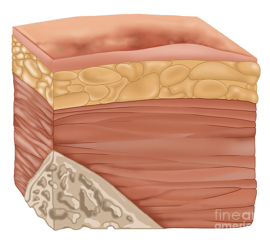 Stage 1 Of A Bedsore, Illustration Photograph by Gwen Shockey - Fine ...