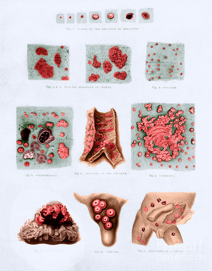 Stages And Types Of Smallpox Photograph by Science Source