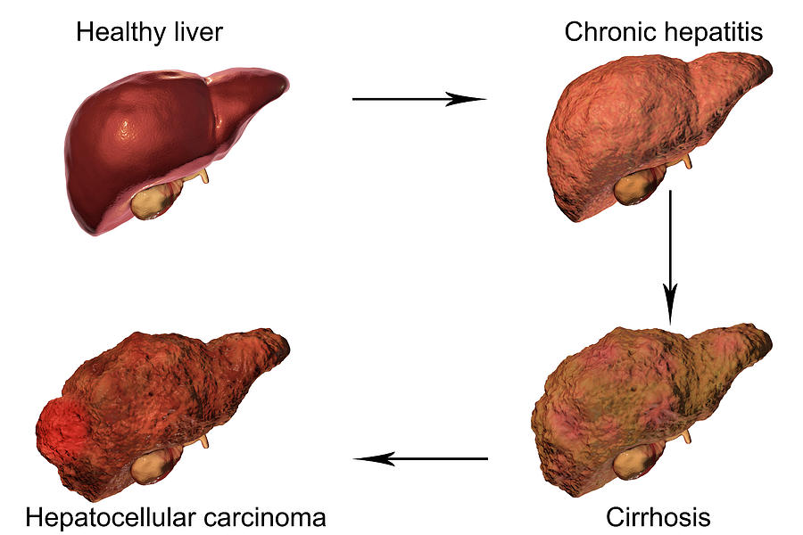 Stages Of Liver Disease Photograph By Kateryna Kon/science Photo ...