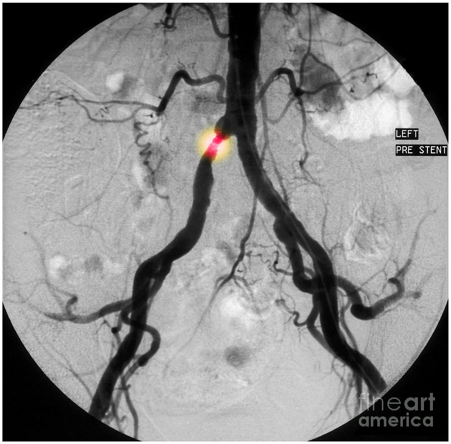Stenosis In Common Iliac Artery 1 Of 2 Photograph by Scott Camazine