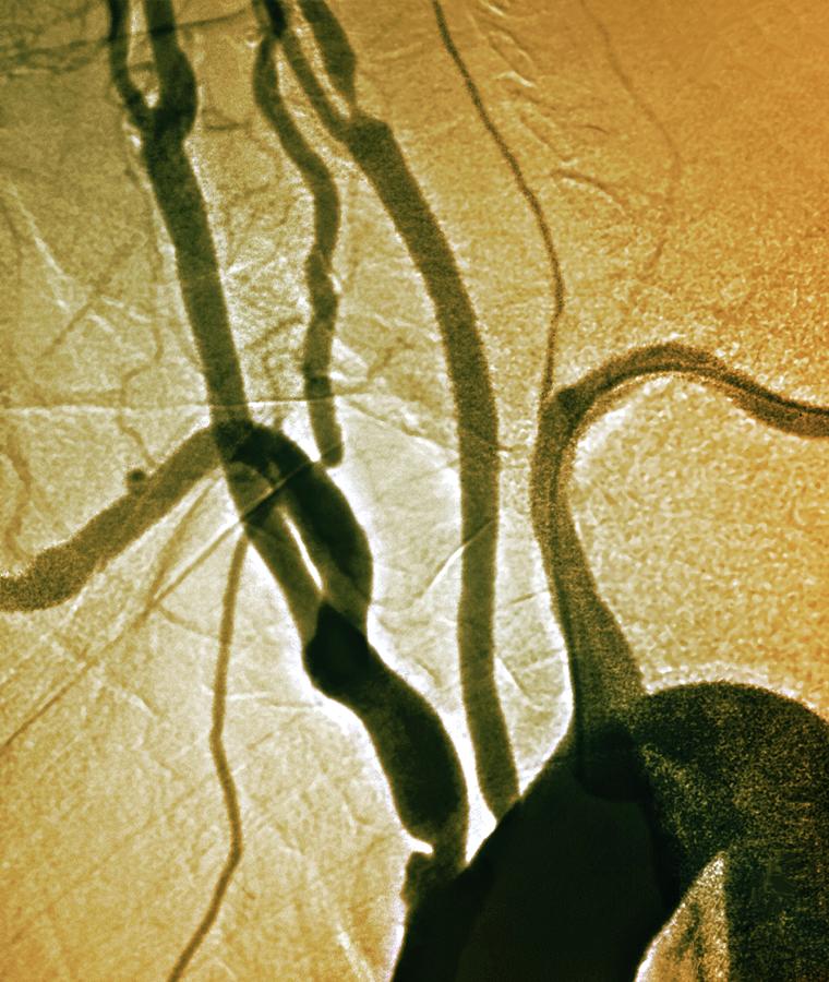 Colour Photograph - Stenosis Of Arteries by Zephyr/science Photo Library Colour Photograph - Stenosis Of Arteries by Zephyr/science Photo Library