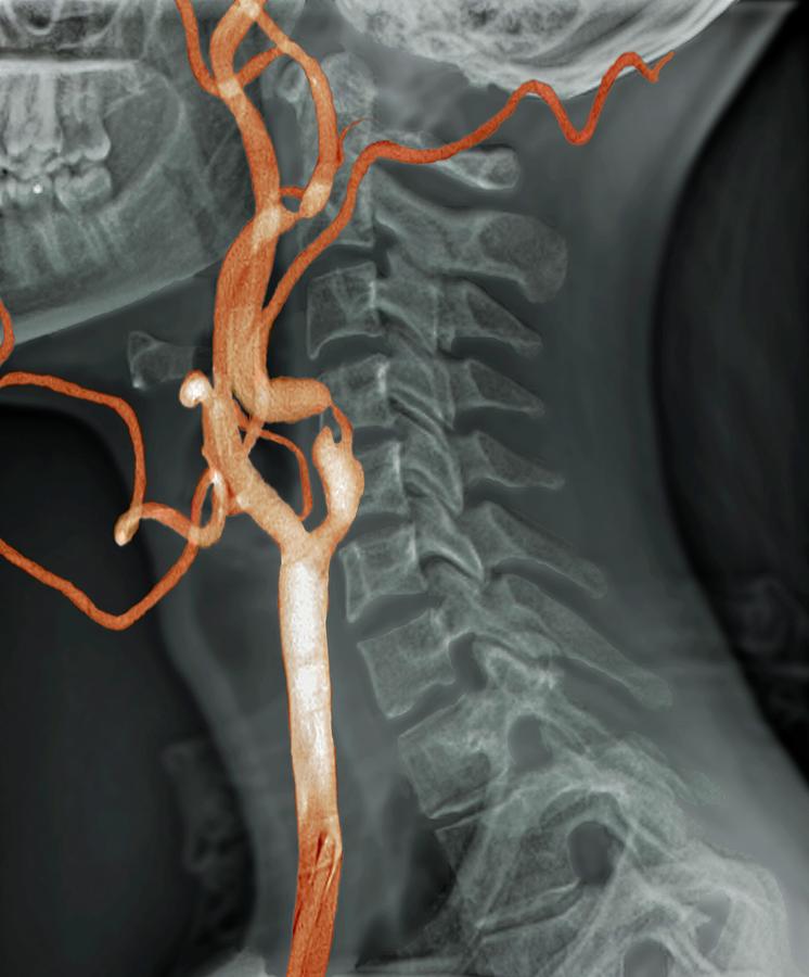 Stenosis Of Carotid Artery By Zephyr/science Photo Library