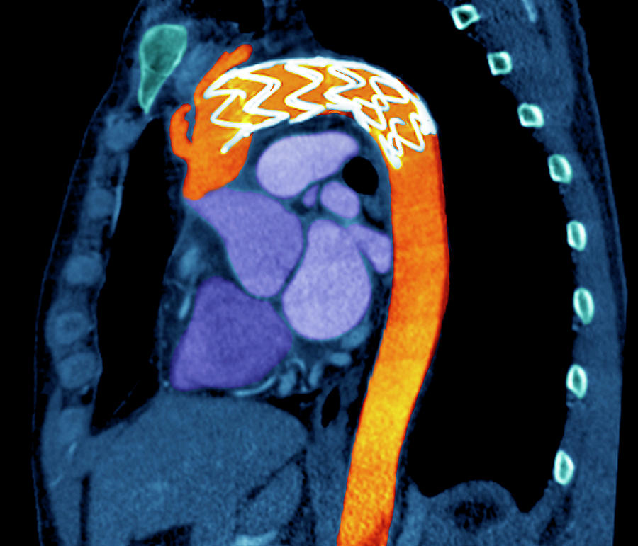 Stent In A Dissecting Aorta Photograph By Zephyr Science Photo Library